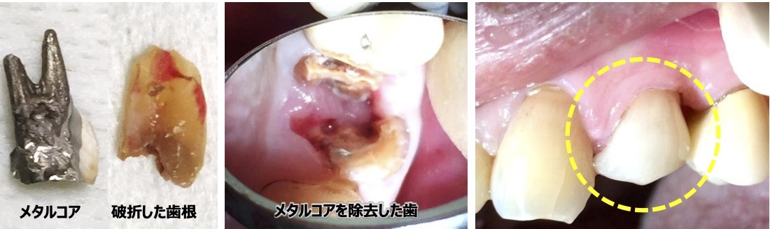 歯が破折する可能性のあるメタルコア 銀合金 パラジウム合金 梅新デンタルクリニック